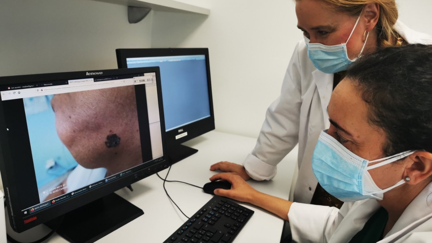 El impacto de la Covid 19 reduce en un 62% la detención precoz del melanoma en el Hospital Costa del Sol