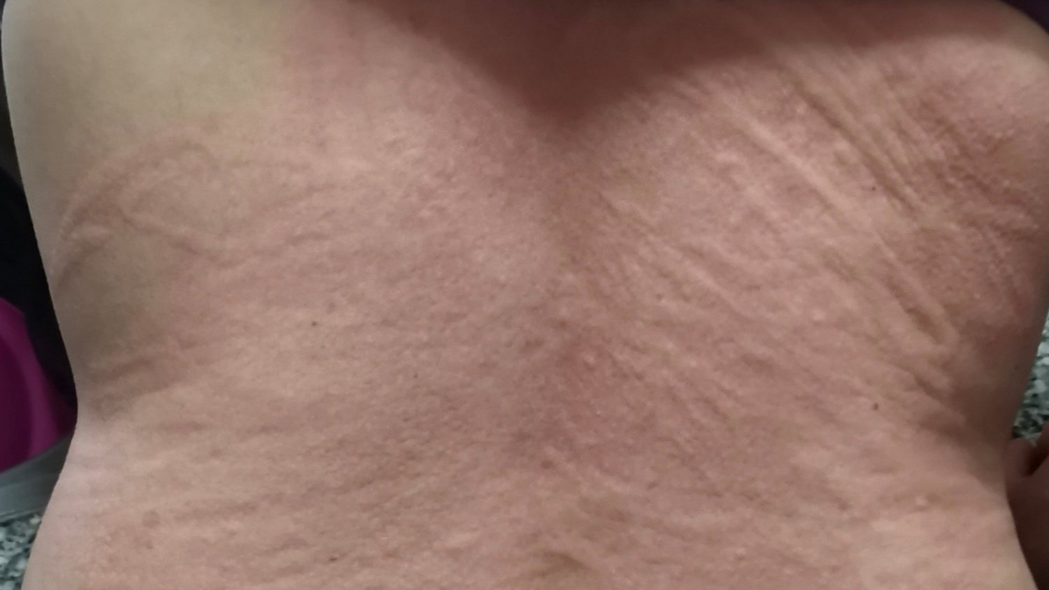 Dermatología del Hospital Costa del Sol participa en un estudio sobre los efectos del Covid-19 en la piel