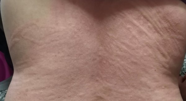 Dermatología del Hospital Costa del Sol participa en un estudio sobre los efectos del Covid-19 en la piel