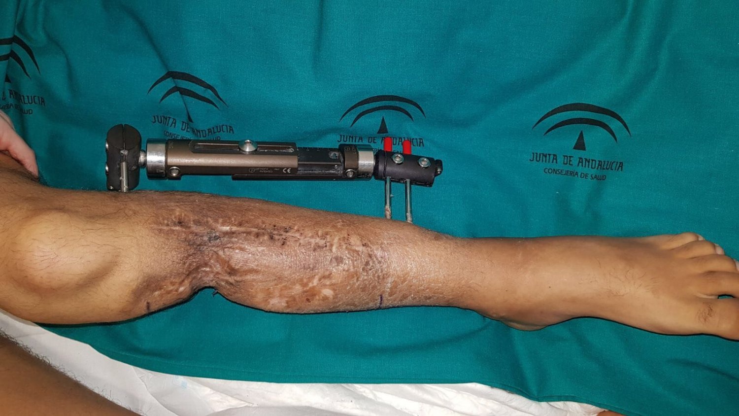 El Hospital Regional realiza un trasplante de peroné a un paciente que volverá a caminar tras varios años sin apoyar el pie