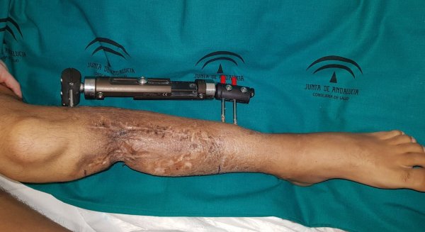 El Hospital Regional realiza un trasplante de peroné a un paciente que volverá a caminar tras varios años sin apoyar el pie