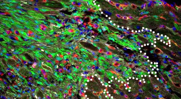 Un grupo de investigación de la UMA lidera un estudio sobre los infartos de miocardio