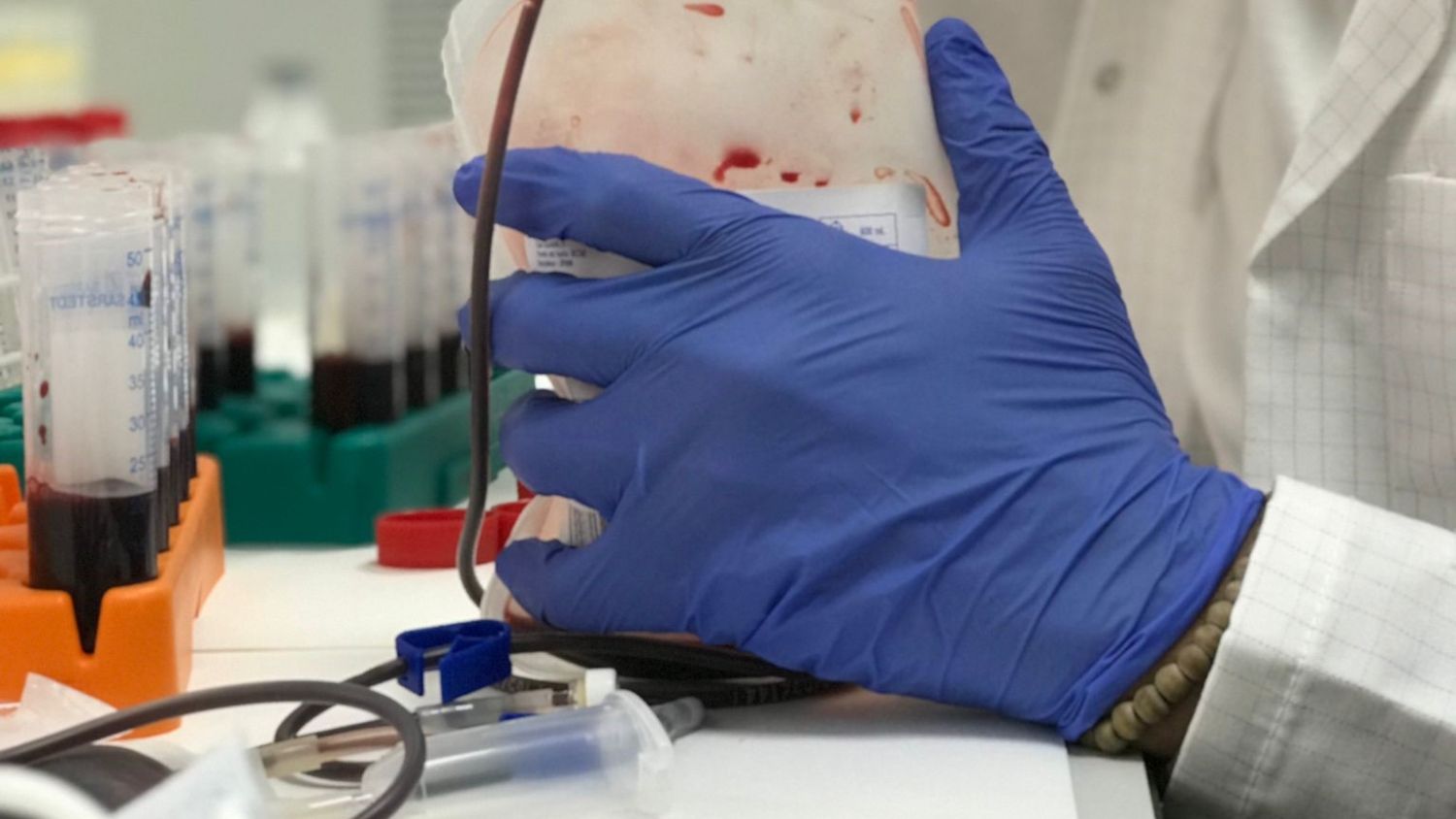 Investigadores de IBIMA desarrollan el diagnóstico de cáncer de mama con una muestra de sangre