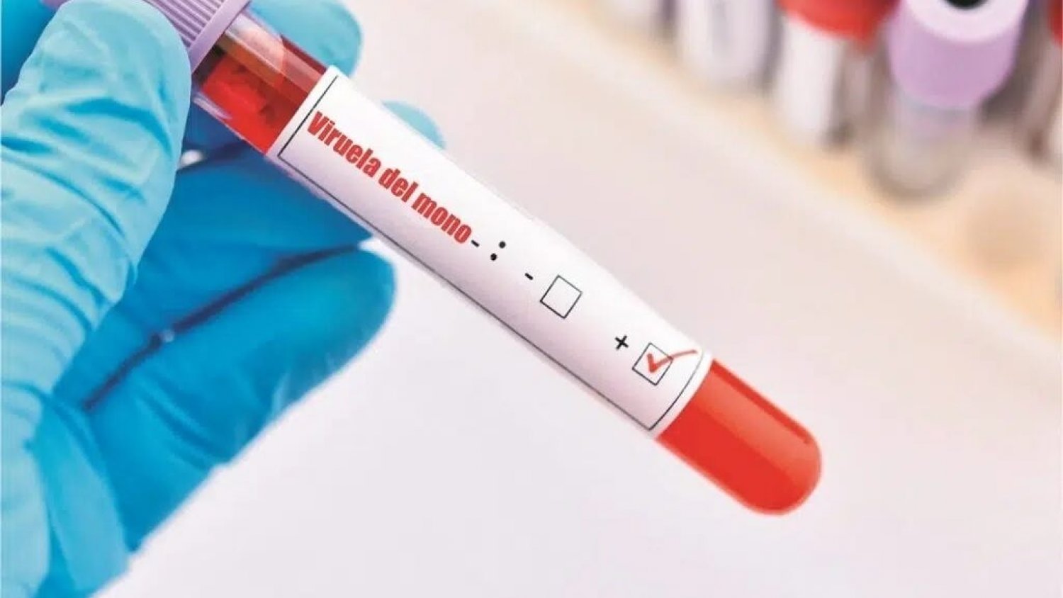 Andalucía registra 146 casos activos de viruela del mono