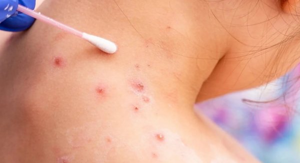Andalucía notifica 356 contagios activos de viruela del mono