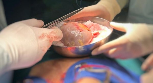 El programa de trasplante renal de pacientes hiperinmunizados de Andalucía logra encontrar un riñón compatible para 417 pacientes
