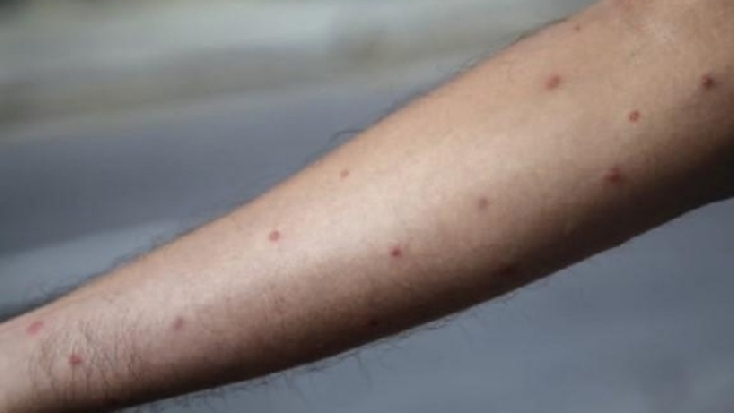 Andalucía confirma 18 casos de viruela del mono y 10 en investigación