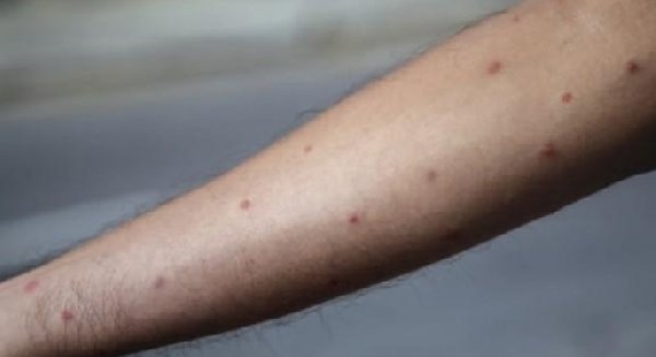 Andalucía confirma 18 casos de viruela del mono y 10 en investigación