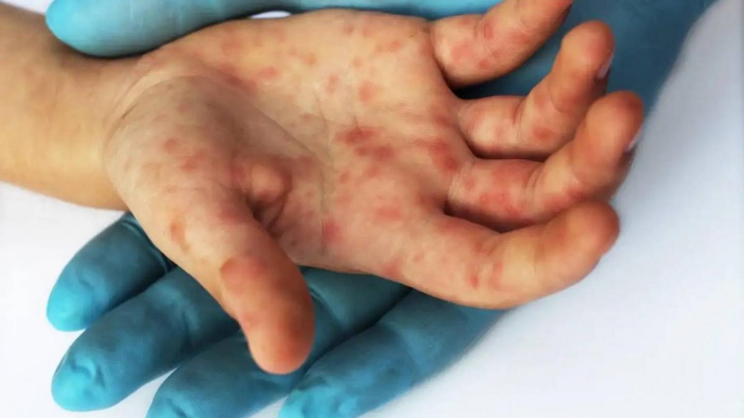 La Junta confirma siete casos por infección de viruela del mono en Andalucía