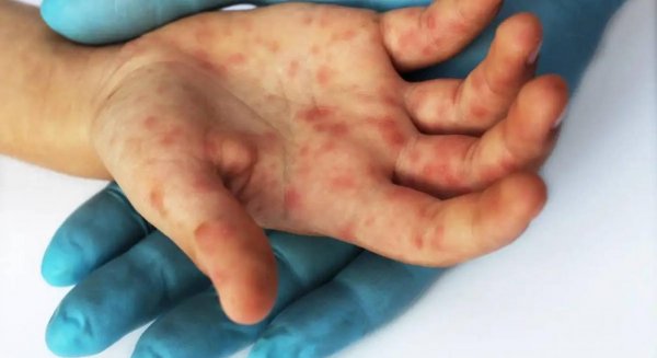 La Junta confirma siete casos por infección de viruela del mono en Andalucía